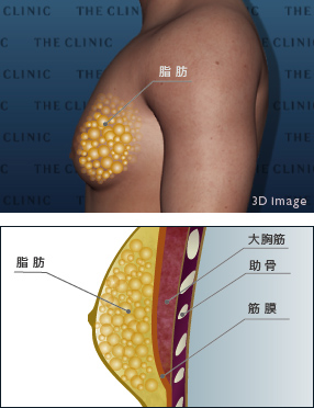 偽性女性化乳房 状態図