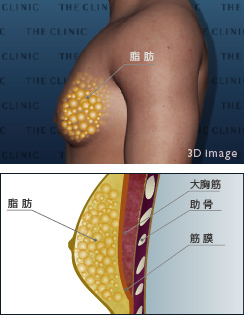偽性女性化乳房 状態図