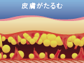 内出血や知覚鈍磨などを引き起こしやすく、ダウンタイムも長く、辛い術後が続きます