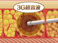 ３G（第３世代）超音波（VASER波）で治療部位の脂肪だけを遊離させます