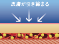 皮下脂肪の90%の除去が可能です