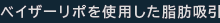 ベイザーリポを使用した脂肪採取