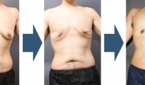 女性化乳房の治療はベイザー脂肪吸引＋サーミタイトが新常識