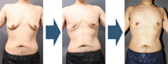 女性化乳房の治療はベイザー脂肪吸引＋サーミタイトが新常識