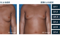 女性化乳房治療と同時に腰回りの脂肪をシェイプアップ