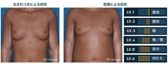 女性化乳房治療と同時に腰回りの脂肪をシェイプアップ