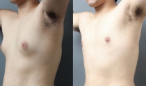 女性化乳房の傷を小さくするコツ！実際の症例写真とともにご紹介