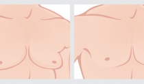 そのしこり、大丈夫？ 女性化乳房と乳がんの見分け方
