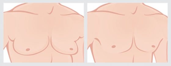 そのしこり、大丈夫？ 女性化乳房と乳がんの見分け方