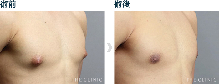 情勢下乳房治療によって乳頭が改善されたケース