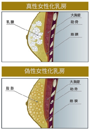 女性化乳房 真性 偽性
