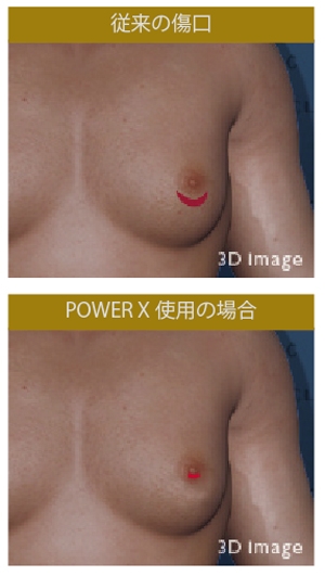 女性化乳房 乳腺切除 傷跡