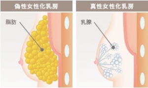 真性女性化乳房、偽性女性化乳房