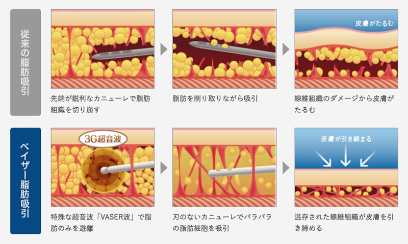 脂肪吸引 ベイザー
