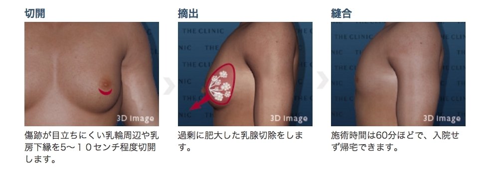真性女性化乳房 乳輪下切開による乳腺摘出