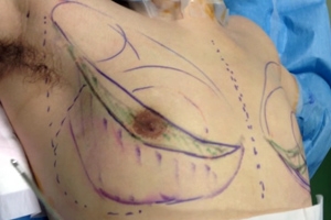 女性化乳房 乳腺切除 脂肪吸引