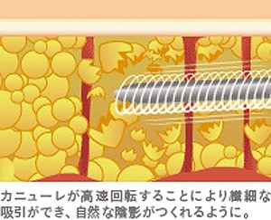 女性化乳房 ベイザー脂肪吸引