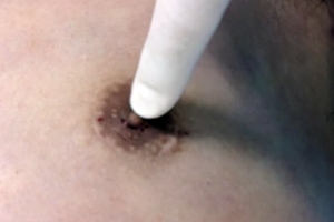 女性化乳房 乳腺切除 傷