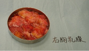 乳腺 切除