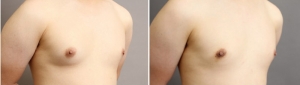 真性女性化乳房 症例