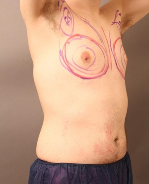 女性化乳房 マーキング 画像