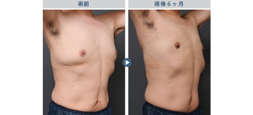 女性化乳房 症例