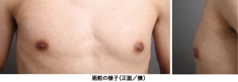 女性化乳房 症例 画像