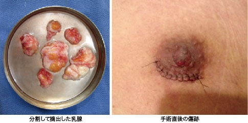 女性化乳房 真性 治療