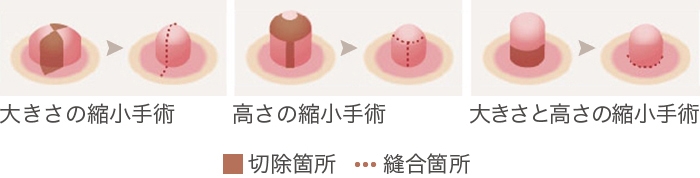 乳頭切除術とは
