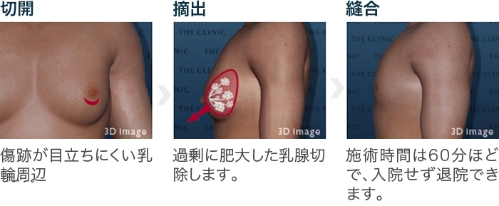 女性化乳房 乳腺切除