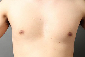 偽性女性化乳房
